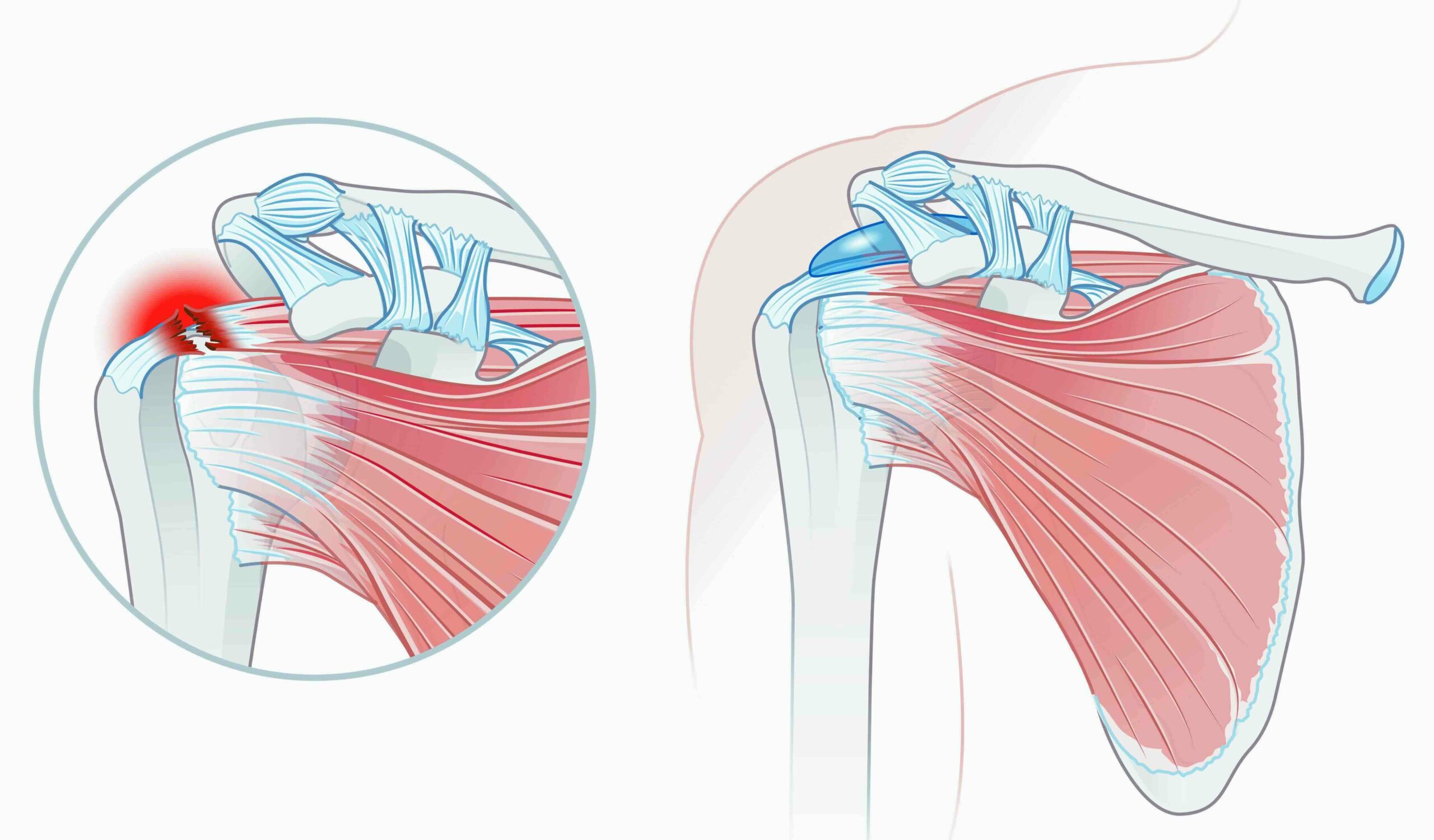 rotator cuff tear